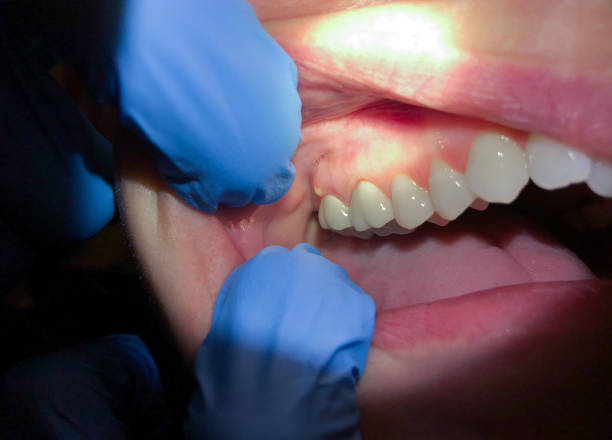 Best Emergency Gum Pain Relief  in Fort Washakie, WY